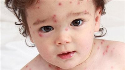 العمر المناسب للحصول على تطعيم الجديري المائي 