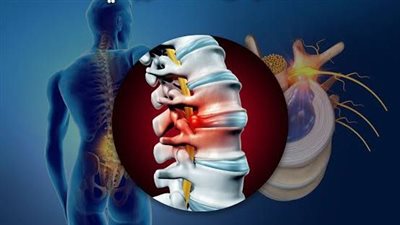 علاج انزلاق الغضروف بالمنزل، ومتى يجب زيارة الطبيب؟