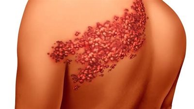 منها مضادات الاكتئاب والفيروسات، هيئة الدواء تكشف عن طرق علاج الحزام الناري 