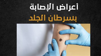 أعراض الإصابة بسرطان الجلد (إنفوجراف)