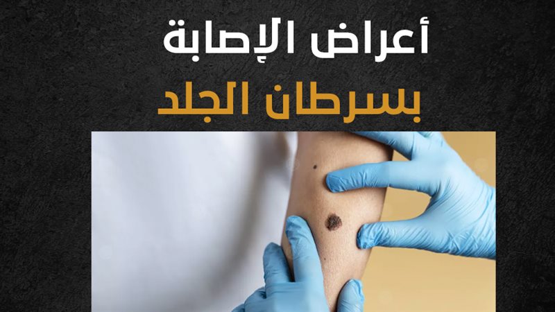 سرطان الجلد، فيتو