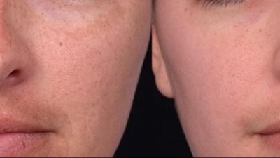 حاربي الكلف فى البشرة بالأفوكادو والعسل