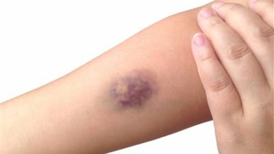 ما هو داء كايلر وأعراضه وطرق علاجه ؟