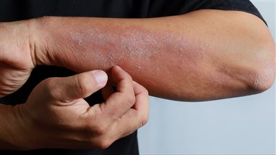 أمراض جلدية خطيرة تستدعي الذهاب للمستشفى وتسبب الوفاة، وهذه الأعراض ( فيديو) 