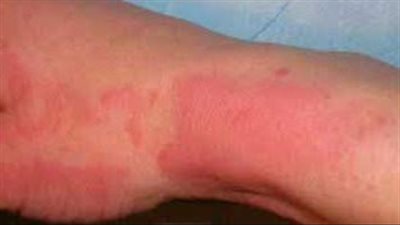 الصحة توضح طرق التعامل مع الحروق في المنزل