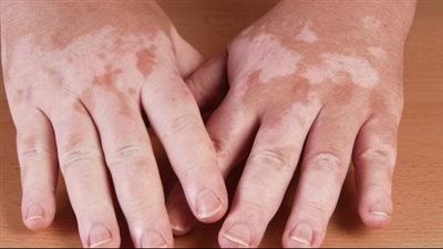 هل البهاق مرض معدٍ؟.. وما هي أسبابه وطرق العلاج؟ 