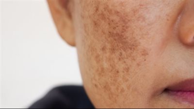 جل القهوة لتفتيح البقع الداكنة بالبشرة