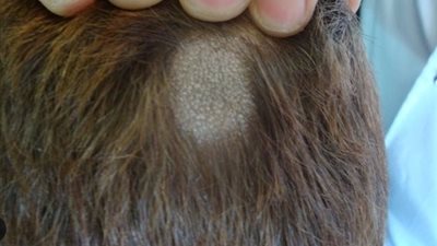 باحثون ينجحون في تطوير مركب جديد قد يحدث طفرة في علاج داء الثعلبة