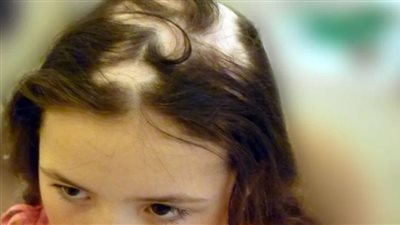 هاني الناظر يكشف سر ظهور الثعلبة عند الأطفال ويحذر الآباء من هذا الفعل