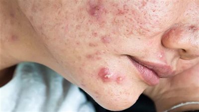  قناع الطماطم والشوفان للتخلص من الحبوب والبثور السوداء 