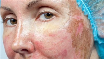 ما حكم التقشير الكيميائي للوجه والكفين من أجل التداوي؟، دار الإفتاء توضح الشروط 