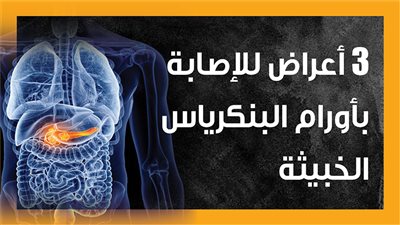 3 أعراض للإصابة بأورام البنكرياس الخبيثة (إنفوجراف)