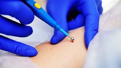 مرض السنط التناسلي، 7 أعراض للإصابة وطرق العلاج والوقاية