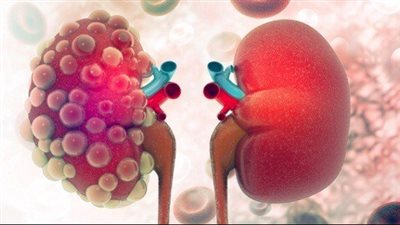 أعراض الفشل الكلوي، يظهر بشكل مفاجئ ويجب الحذر من أسبابه