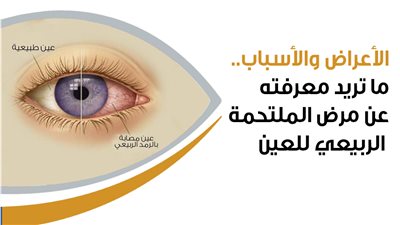 الأعراض والأسباب.. ما تريد معرفته عن مرض الملتحمة الربيعي للعين (إنفوجراف)
