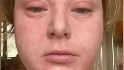 اسكتلندية أرادت تجميل أسنانها بالفينير فأصيبت بجلد الفيل