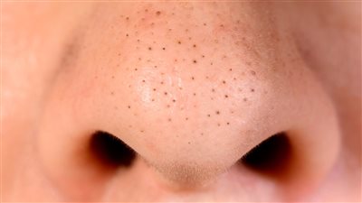  وصفة طبيعية لعلاج البثور السوداء سريعا