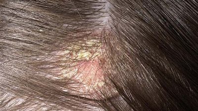 تخلصي من قشرة الشعر بالقرفة وجوز الهند