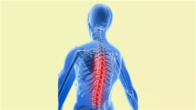 آلام الظهر الشديدة، علامة للإصابة بأورام العمود الفقري