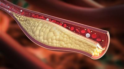 نظام غذائي لمدة أسبوع لعلاج ارتفاع الكوليسترول بالدم 