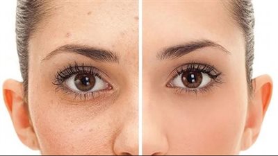 كريم العرقسوس لنضارة البشرة وإزالة البقع والتصبغات