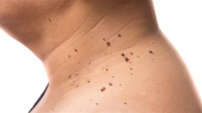 لتجنب مرض السكر، أعراض الإصابة بمقاومة الأنسولين وهذه طرق العلاج 