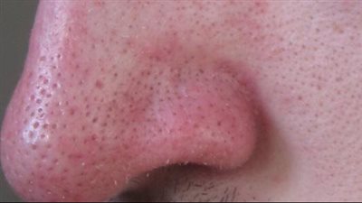 وصفة طبيعية لعلاج البثور السوداء سريعا