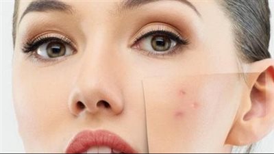 قناع العسل وزيت الزيتون لعلاج حبوب الشباب 