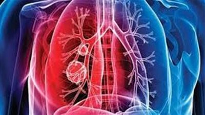 العلامات المبكرة لمرض السل، وطرق العلاج المختلفة