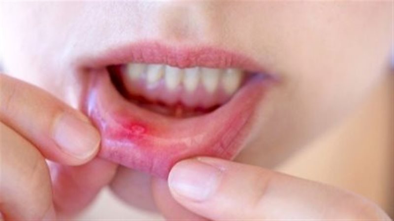 علاج حالات الشفة،