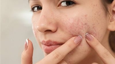 أسباب ظهور حب الشباب، وهل يعالج معجون الأسنان الحبوب؟