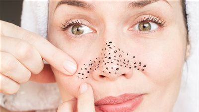 وصفة طبيعية للتخلص من الندوب بالبشرة والبثور السوداء