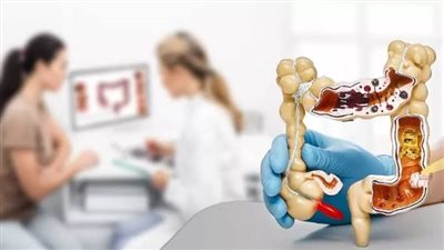   أعراض القولون العصبي عند النساء، الصداع النصفي أبرزها