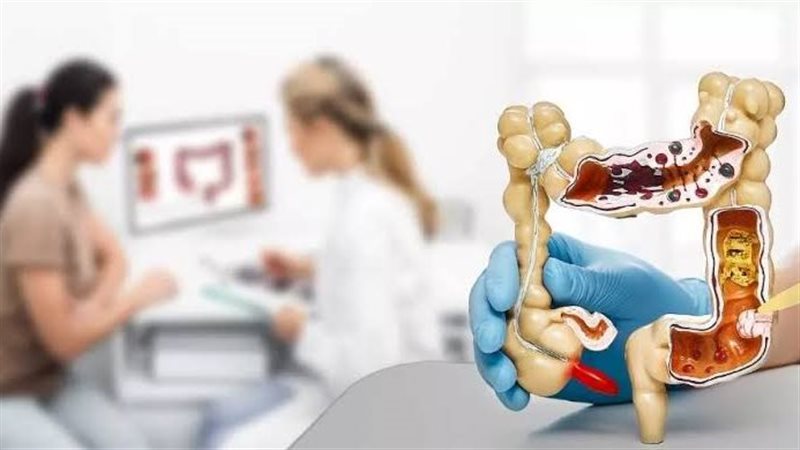 أعراض القولون العصبى