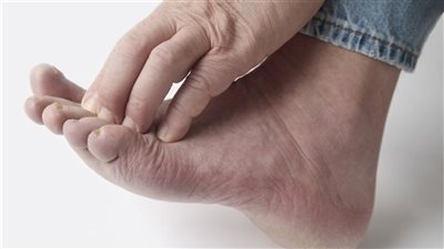 العلماء وصفوها بالمثيرة للجدل.. دراسة تكشف علاقة تورم أصابع القدم بكورونا