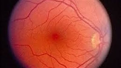 في اليوم العالمي لأمراض الشبكية، نصائح لمرضى السكر لمنع الإصابة بفقدان البصر