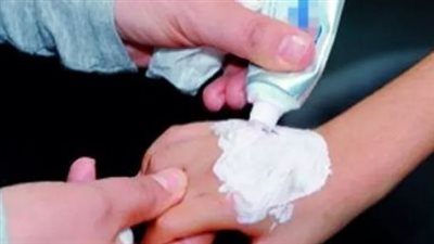  الصحة تحذر من استخدام معجون الأسنان على الحروق لهذا السبب 