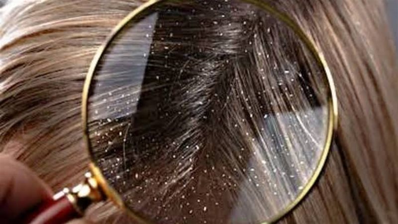 علاج قشرة الرأس،