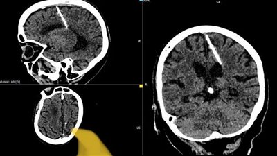 مسنة روسية تتعايش مع إبرة في دماغها منذ 80 عاما