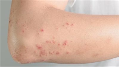 ما هو مرض انحلال البشرة الفقاعي وهل يسبب سرطان الجلد؟