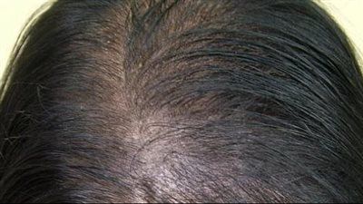 وصفة طبيعية بمكونات بسيطة تقضي على فراغات الشعر 