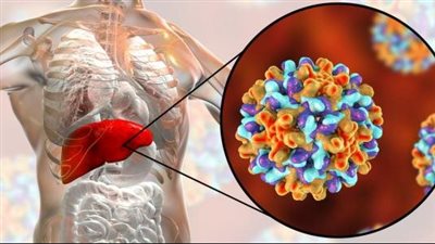 أعراض التهاب الكبد الوبائي، وطرق العلاج والوقاية