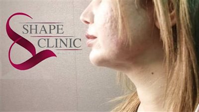 لجمال الوجه.. نحت اللغلوغ في مستوصف شيب كلينك