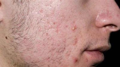 أفضل علاج لحب الشباب، التغذية السليمة والوصفات الطبيعية 