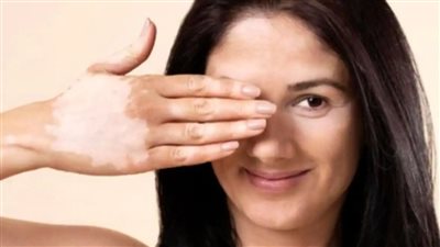 تأثير مرض أديسون المناعي على البشرة وطرق علاجه