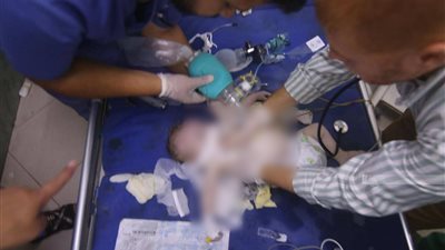 إنعاش رضيعة بعد انتشالها من تحت الأنقاض في غزة 