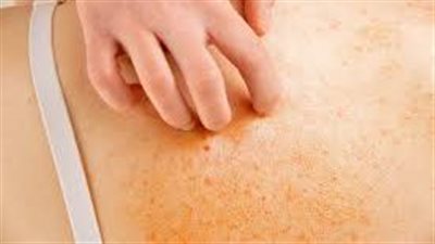  كيف تحدث الإصابة بالجرب، هذه أعراضه وطرق للعلاج 