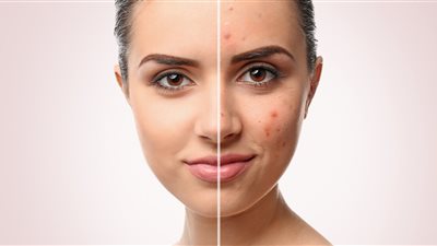 تخلصى من آثار الحبوب على البشرة بمكونين اثنين فقط