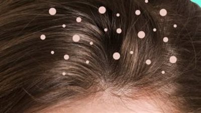 وصفة طبيعية لعلاج قشرة الشعر بالماء والليمون 