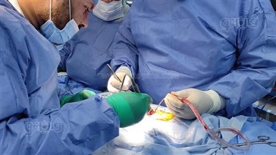 إجراء جراحة انتقاء وفصل الأعصاب الظهرية بالقناة الشوكية لطفل مصاب بالشلل الدماغي في جامعة طنطا